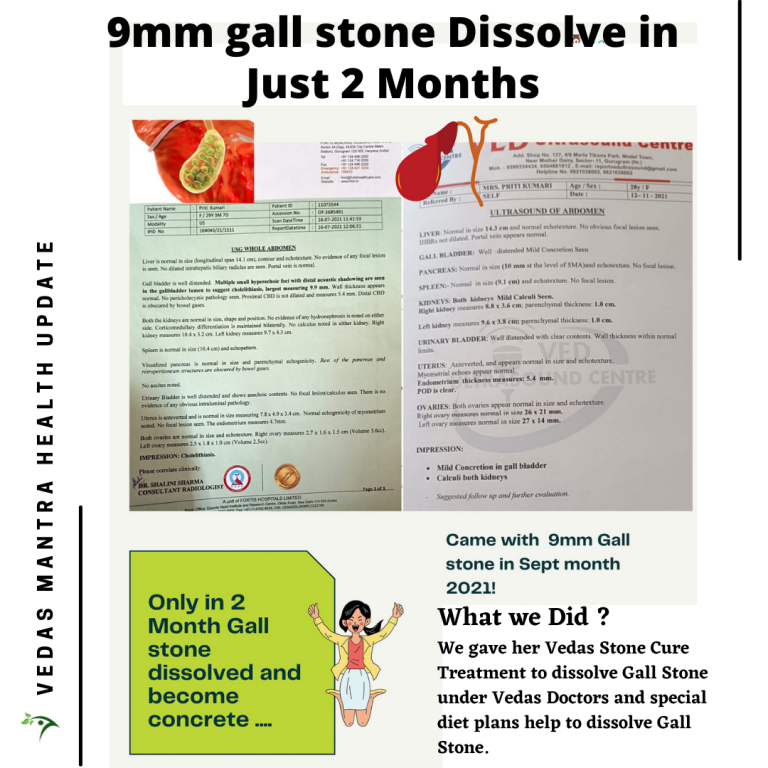 Gall Stone Result Priti (2)