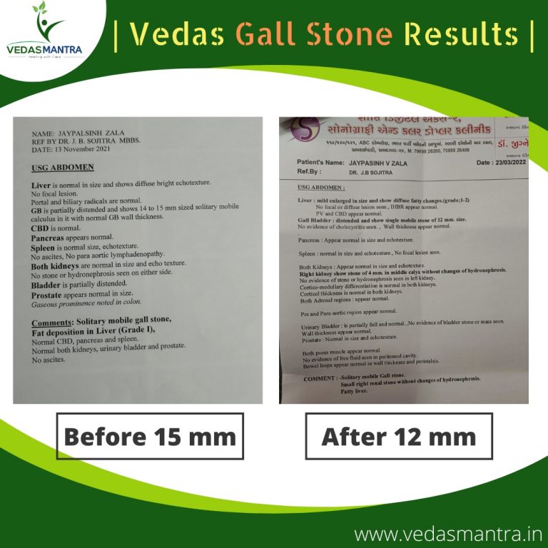 gall stone jpg